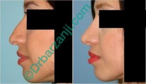 یک سال بعد از جراحی پلاستیک بینی