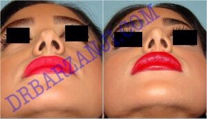 جراحی بینی،ترمیم