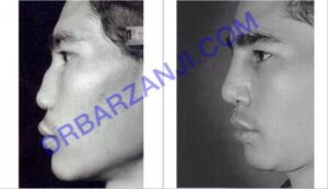 جراحی ترمیمی بینی