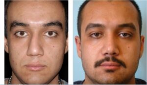 جراحی بینی، یک سال بعد از عمل