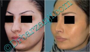 عمل جراحی پلاستیک بینی ( رینوپلاستی )