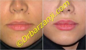 تزریق ژل در لب ها