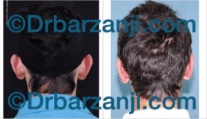جراحی ترمیمی برجستگی لاله گوش