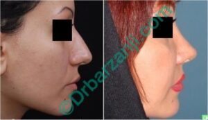 جراحی پلاستیک بینی هفت سال بعد از عمل