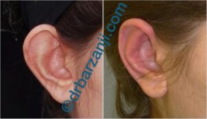 جراحی برجستگی لاله گوش
