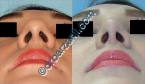 جراحی پلاستیک بینی یک سال بعد از عمل