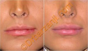 تزریق ژل جوویدرم ( ژوویدرم ) به لب یک ماه بعد