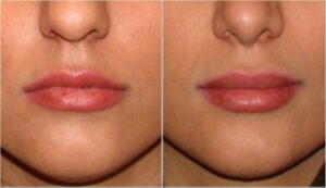 تزریق جوویدرم در لب ، یک سال و نیم بعد