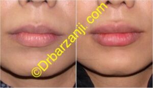 تزریق ژل ژوویدرم به لب