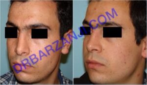 جراحی بینی، شش ماه بعد از عمل