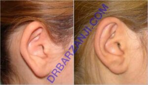 عمل جراحی لاله گوش برجسته