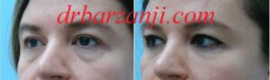 تزریق ژل رستیلن زیر چشم ها- شش ماه بعد