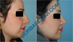 جراحی بینی یک سال بعد از عمل