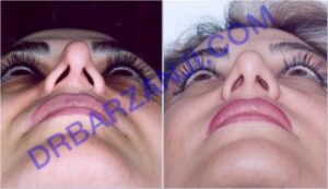 رینوپلاستی ثانویه