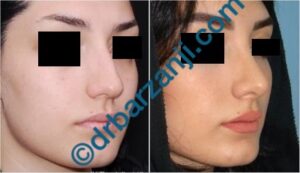 جراحی بینی یک سال و نیم بعد از عمل