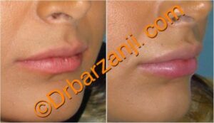 تزریق ژل جوویدرم ( ژوویدرم ) به لب یک ماه بعد