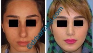 جراحی بینی و پروتز چانه چهار سال بعد از عمل