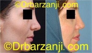 جراحی ترمیمی بینی شش سال بعد از عمل
