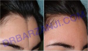 تزریق چربی در پیشانی( فرورفتگی مادرزادی)