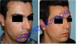 جراحی بینی، شش ماه بعد از عمل