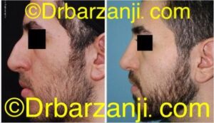 جراحی بینی دو سال بعد از عمل