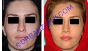 جراحی پلاستیک بینی، 4 سال بعد