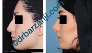 جراحی بینی یک سال و نیم بعد از عمل