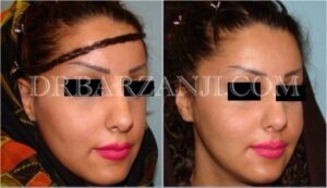 پروتز گونه، دو ماه و نیم بعد از عمل