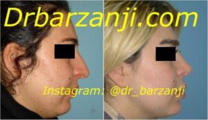 جراحی بینی و پروتز چانه