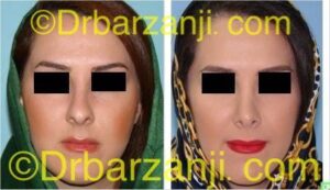 عمل جراحی زیبایی بینی یک سال بعد