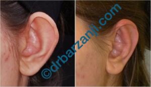 جراحی برجستگی لاله گوش