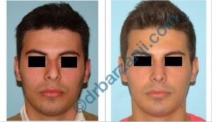 جراحی بینی و پروتز چانه 6 ماه بعد از عمل