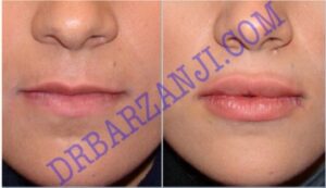 ژل جوویدرم در لب بالا و پایین، ٥ هفته بعد