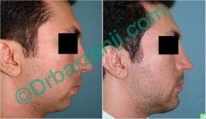 پروتز چانه دو هفته بعد از عمل