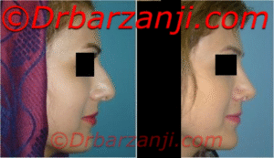 عکس قبل و بعد جراحی پلاستیک بینی شش ماه بعد