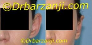 جراحی برجستگی لاله گوش