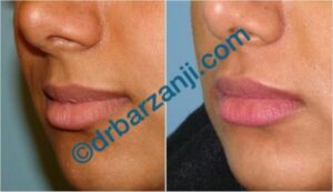 تزریق ژل جوویدرم در لب