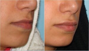 تزریق ژل جوویدرم (ژوویدرم )در لب