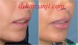 تزریق ژل جوویدرم در لب