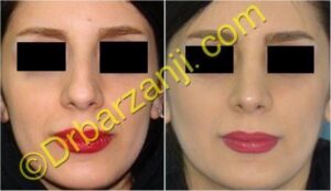 جراحی بینی سه ماه بعد از عمل