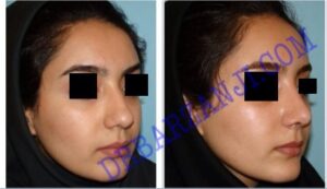 جراحی بینی ، ٣ ماه بعد از عمل