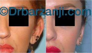 جراحی پلاستیک لاله گوش یک سال بعد از عمل