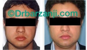 تزریق چربی در ناحیه فک پایین سمت چپ