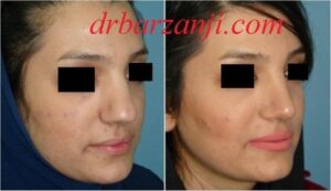 جراحی بینی کج