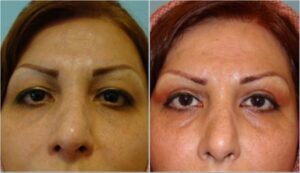جراحی پلک (بلفاروپلاستی) فوقانی ۳ سال بعد از عمل