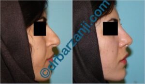 جراحی بینی یک ماه بعد از عمل