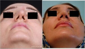 جراحی ترمیمی بینی