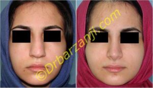 جراحی بینی گوشتی یک سال بعد از عمل
