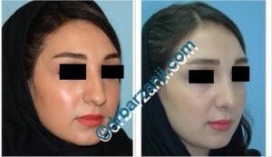 جراحی پلاستیک بینی یک سال بعد از عمل