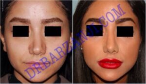 جراحی بینی،ترمیم